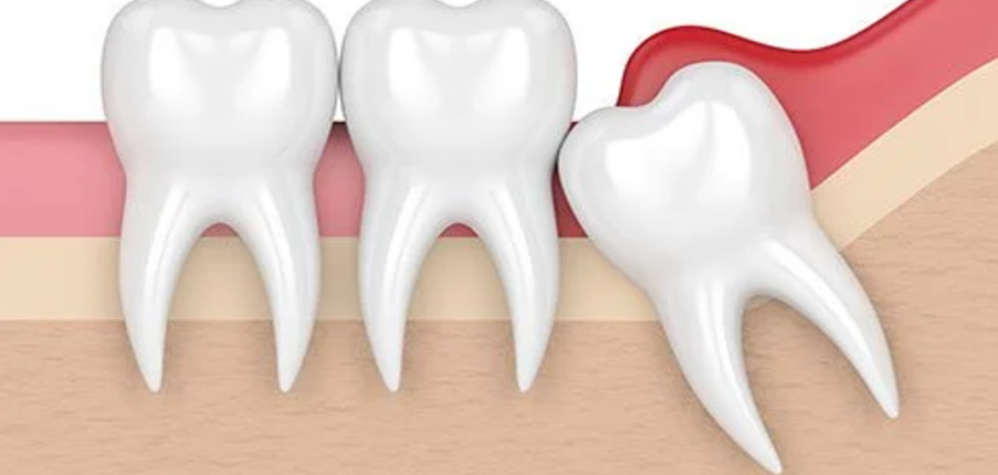 Nguyên nhân nào gây viêm quanh thân răng? Chẩn đoán và điều trị