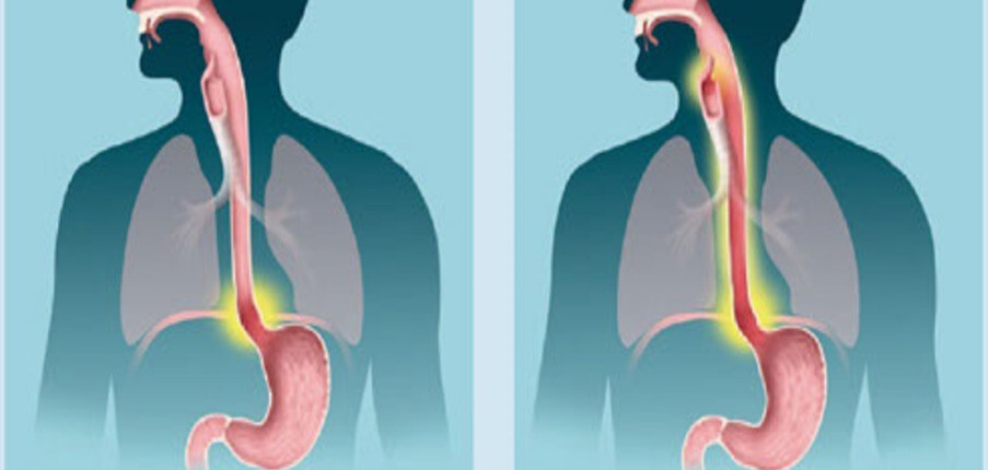 Phân biệt trào ngược họng – thanh quản (LPR) và trào ngược dạ dày – thực quản (GERD)