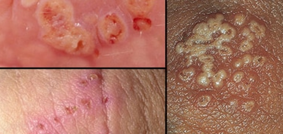 Nguyên nhân, triệu chứng và cách điều trị bệnh Herpes