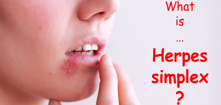 5 điều bạn cần biết về nhiễm vi rút Herpes Simplex