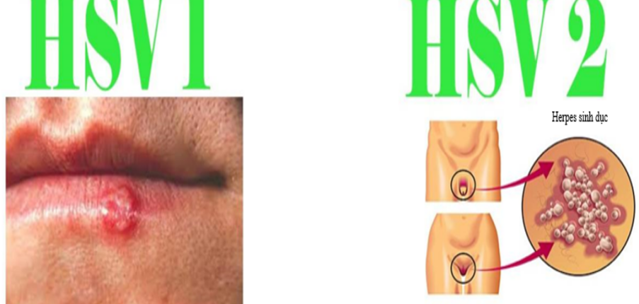 Herpes: những dấu hiệu đầu tiên cần chú ý, điều trị và phòng ngừa