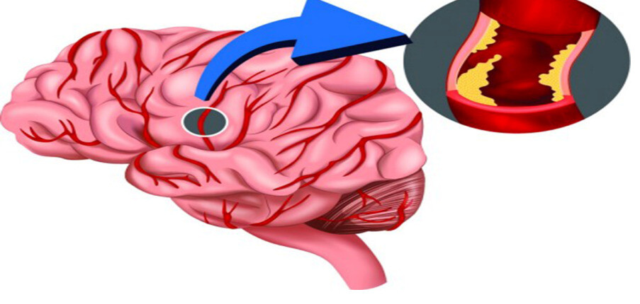Những điều cần biết về đột quỵ do thiếu máu cục bộ