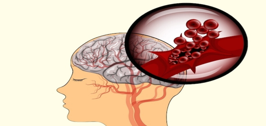 10 điều cần biết về đột quỵ xuất huyết não