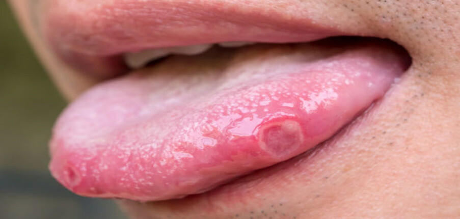 7 điều cần biết về loét miệng: nguyên nhân, triệu chứng, điều trị và dự phòng