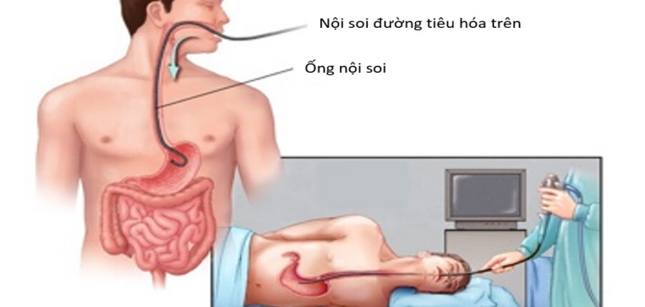 Chẩn đoán và điều trị xuất huyết tiêu hoá