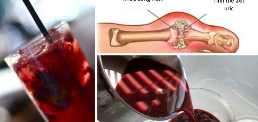 Liệu nước ép cherry có giúp ngăn ngừa và điều trị những cơn gout cấp?