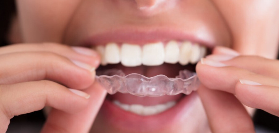 Có thể làm đều răng mà không cần niêng răng không?