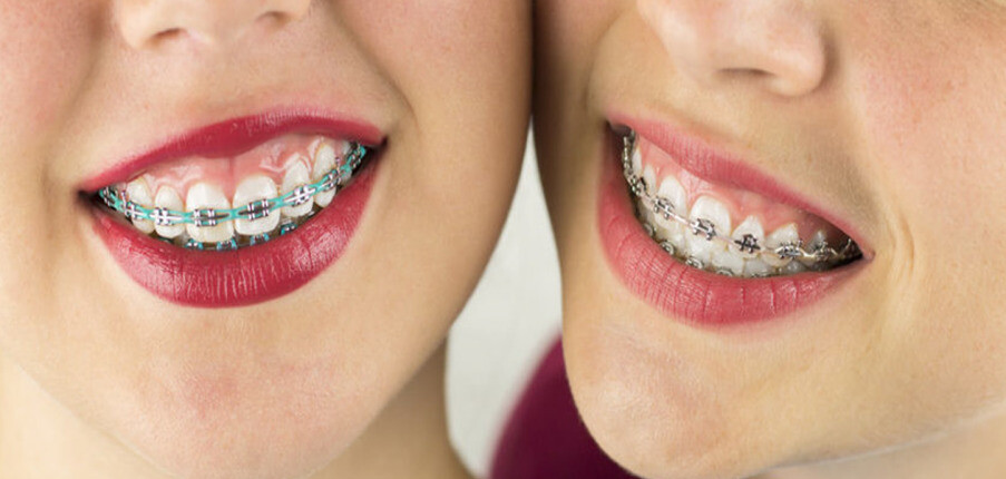 Giữ răng trắng sáng trong quá trình niềng răng
