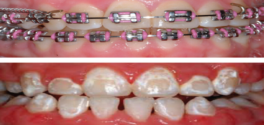 Việc đổi màu răng do niềng răng có kéo dài vĩnh viễn không?