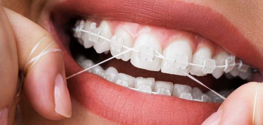 Cách dùng chỉ tơ nha khoa khi đeo niềng răng