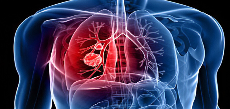 Vai trò của xét nghiệm di truyền trong ung thư phổi