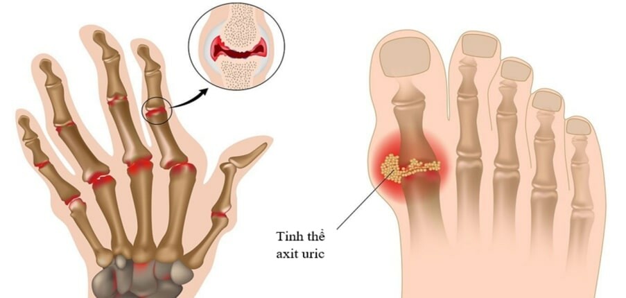 Viêm khớp dạng thấp và gút: Triệu chứng và nguyên nhân