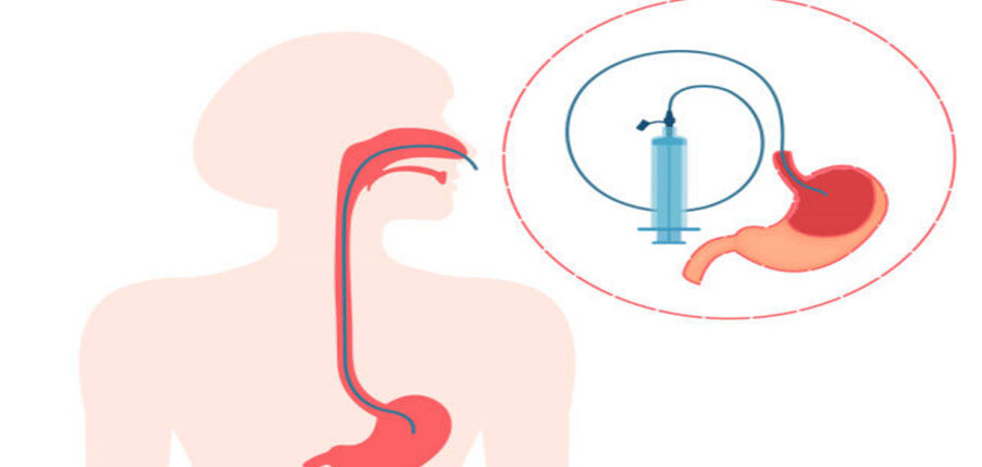 Đặt ống thông mũi – dạ dày: Chỉ định, cách thực hiện và chăm sóc