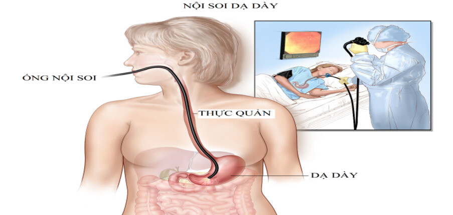 Sinh thiết và nuôi cấy mô dạ dày: Mục đích và quy trình thực hiện