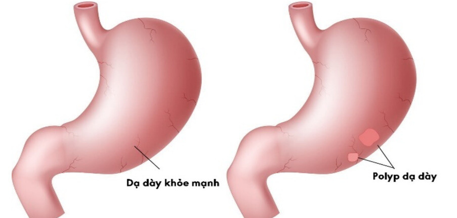 Những điều cần biết về bệnh polyp dạ dày: Nguyên nhân, triệu chứng, chẩn đoán và điều trị