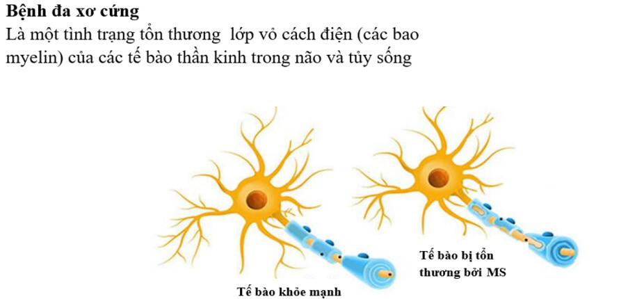 Nhiễm H. pylori có thể bảo vệ phụ nữ khỏi bệnh đa xơ cứng