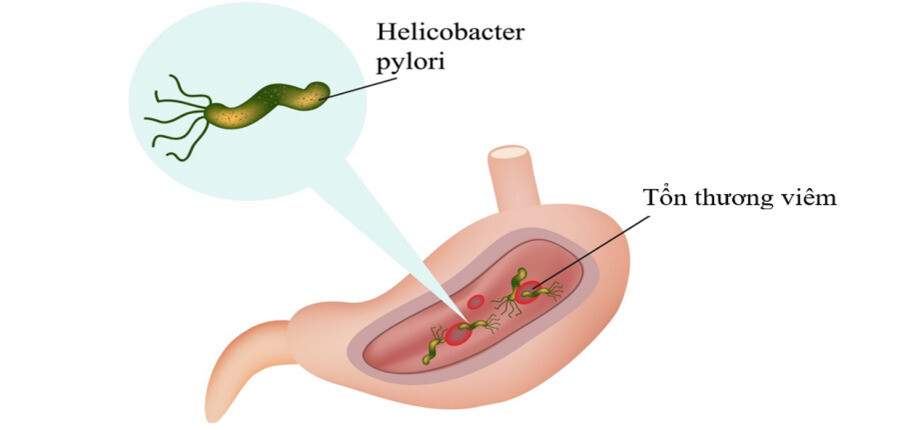 Xét nghiệm tìm vi khuẩn Helicobacter Pylori (H. Pylori)