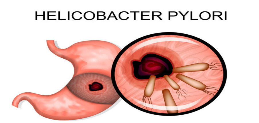 Vi khuẩn H. pylori có lây không? Triệu chứng, chẩn đoán và điều trị