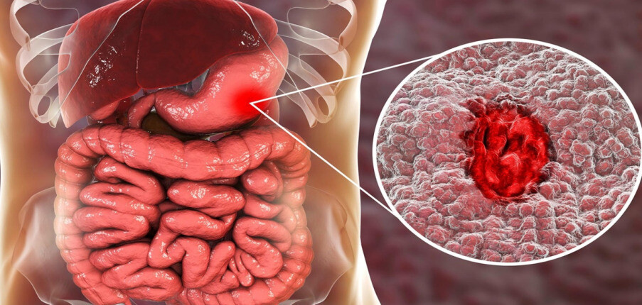 Bệnh loét dạ dày và biến chứng có thể xảy ra