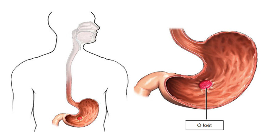 Triệu chứng và nguyên nhân gây bệnh viêm loét dạ dày tá tràng