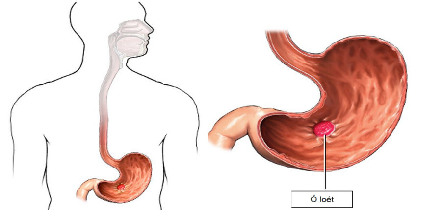 Chẩn đoán và điều trị bệnh viêm loét dạ dày tá tràng