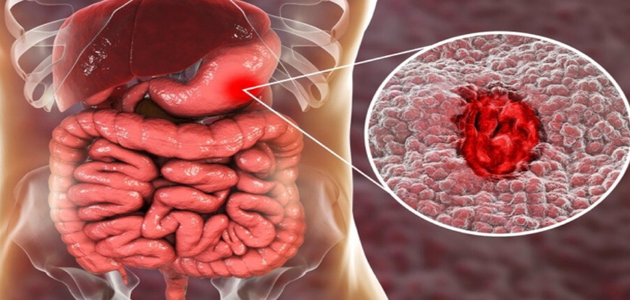 Viêm dạ dày- tá tràng là gì? Nguyên nhân, triệu chứng, chẩn đoán và điều trị