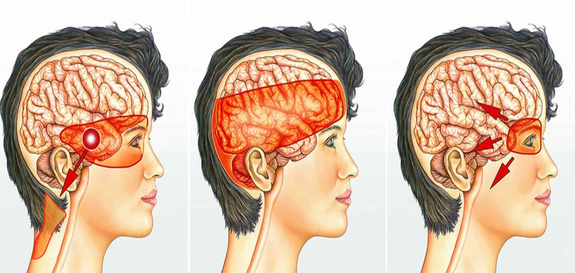 Đau đầu dạng căng thẳng (Tension headache)