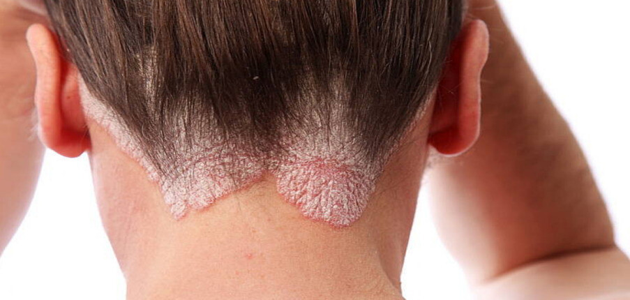 Nấm da đầu: Nguyên nhân, dấu hiệu nhận biết và cách điều trị hiệu quả