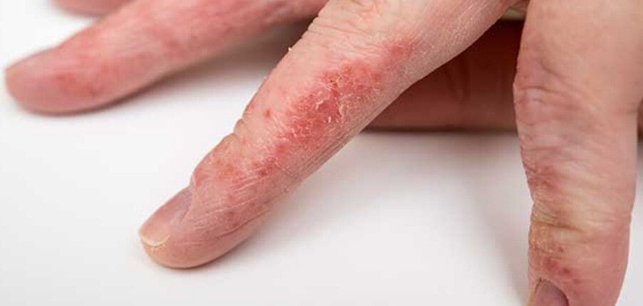 Bệnh chàm (eczema): Nguyên nhân, phân loại, triệu chứng, biến chứng, biện pháp điều trị và phòng ngừa