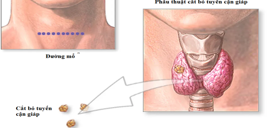 Phẫu thuật cắt bỏ tuyến cận giáp: chỉ định, phương pháp phẫu thuật và chăm sóc sau mổ