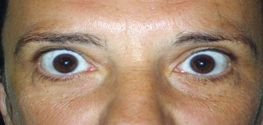 Tổn thương mắt do Basedow: Nguyên nhân, chẩn đoán và điều trị
