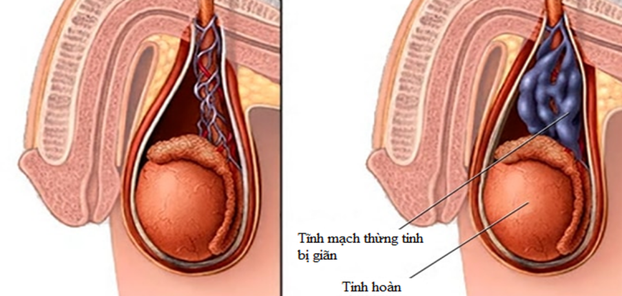 Giãn tĩnh mạch thừng tinh: Triệu chứng, nguyên nhân, chẩn đoán, điều trị và chăm sóc