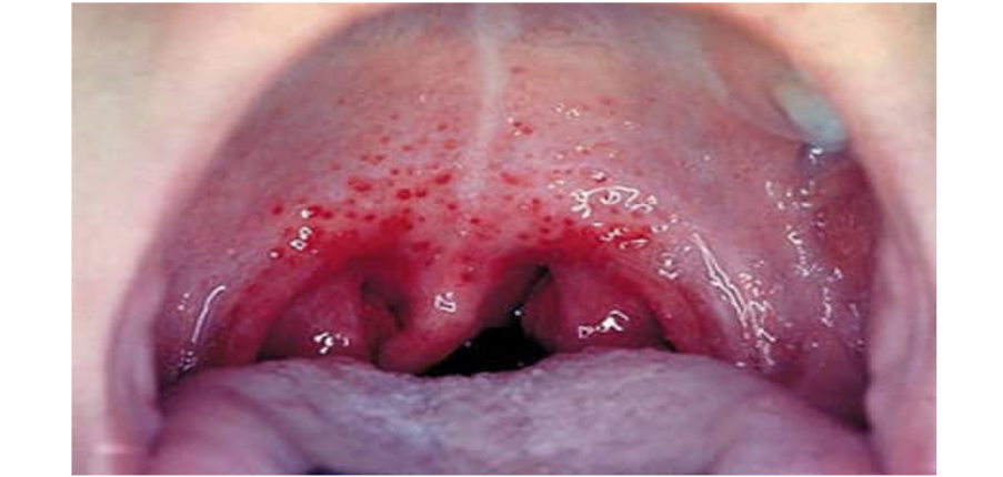 Bệnh lậu ở miệng: Triệu chứng, chẩn đoán, điều trị và các biện pháp phòng bệnh