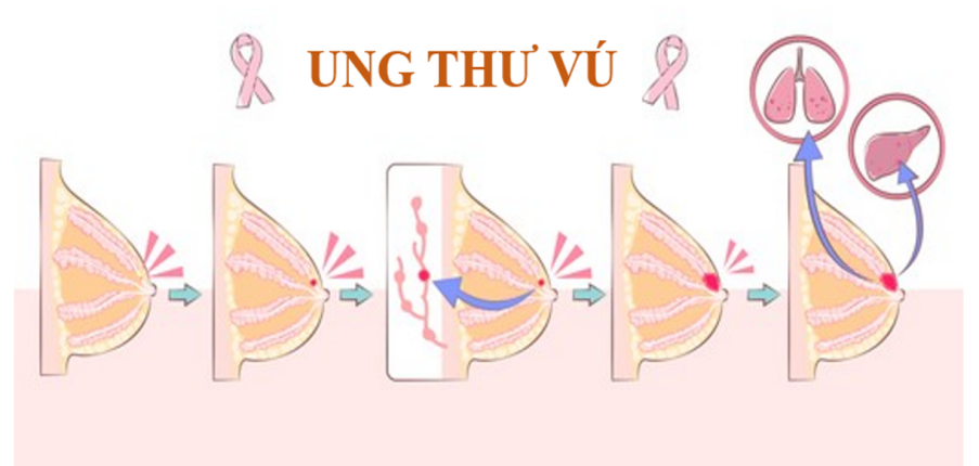 5 giai đoạn của ung thư vú