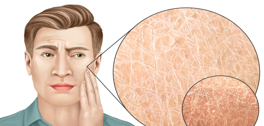 Da mặt khô: Nguyên nhân, biện pháp cải thiện và phòng ngừa