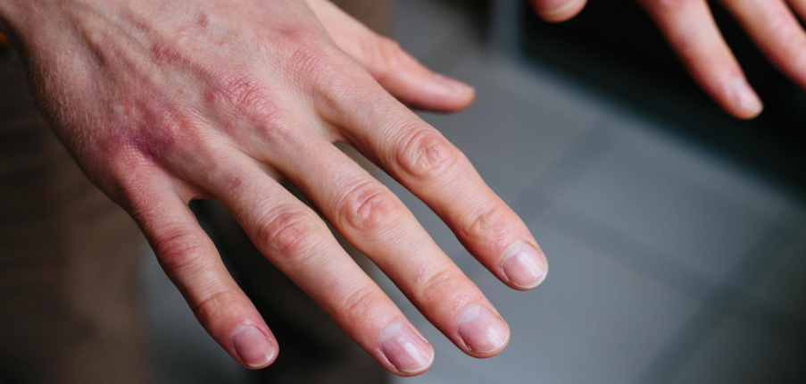 Da tay bị khô: Nguyên nhân, cách khắc phục và phòng ngừa