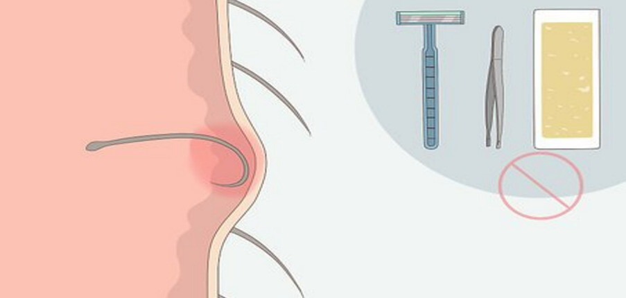 6 điều cần biết về lông mu mọc ngược: Nguyên nhân, điều trị và phòng ngừa