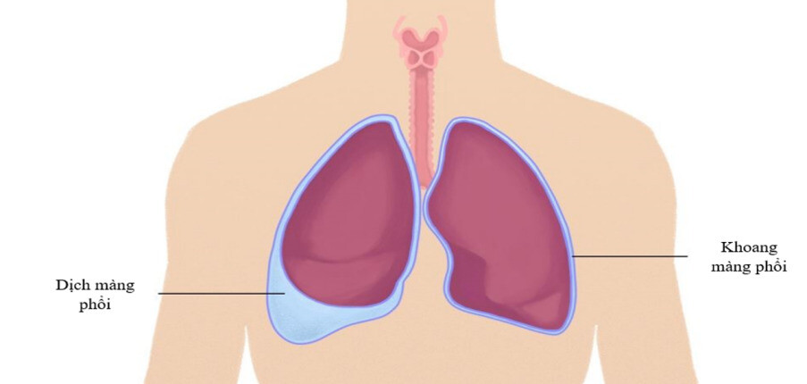 Tràn dịch màng phổi: Nguyên nhân, triệu chứng, biến chứng, điều trị và chăm sóc