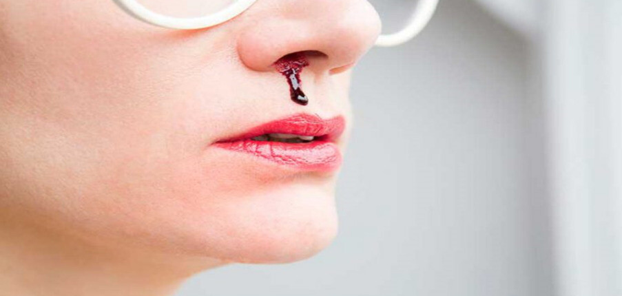 Chảy máu mũi (chảy máu cam): Nguyên nhân, xử lý, điều trị và phòng ngừa