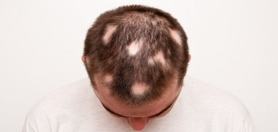 Rụng tóc từng mảng: Nguyên nhân, dấu hiệu nhận biết, chẩn đoán và điều trị
