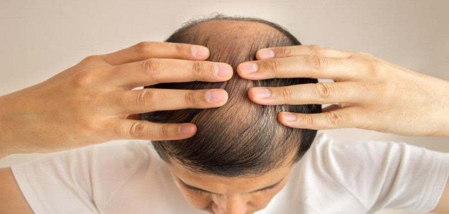 Điều trị rụng tóc ở nam giới: 17 phương pháp hữu hiệu