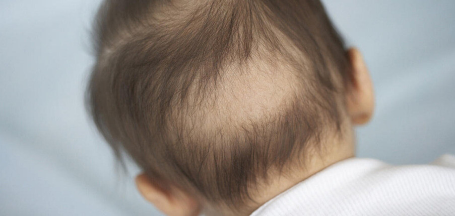 Rụng tóc ở trẻ sơ sinh có bình thường không? Nguyên nhân và biện pháp khắc phục