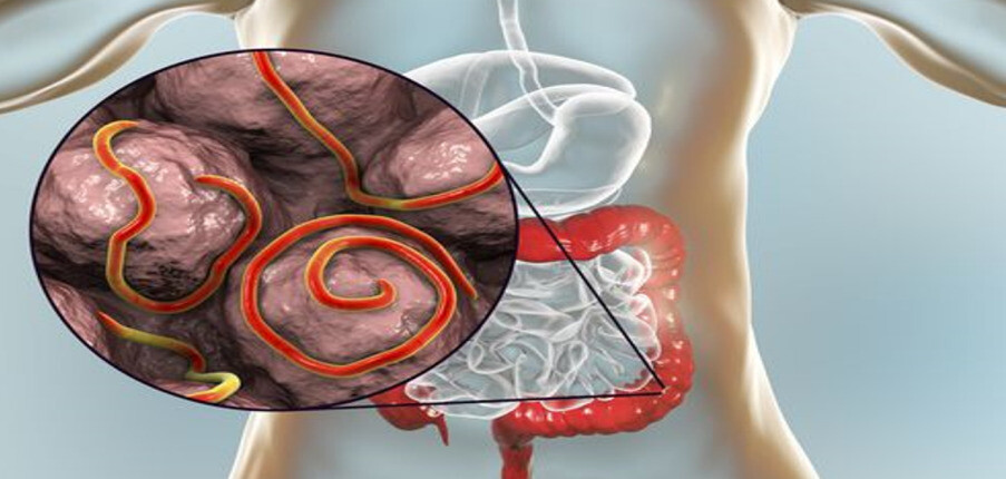 Nhiễm giun kim: Triệu chứng, chẩn đoán, điều trị và phòng ngừa
