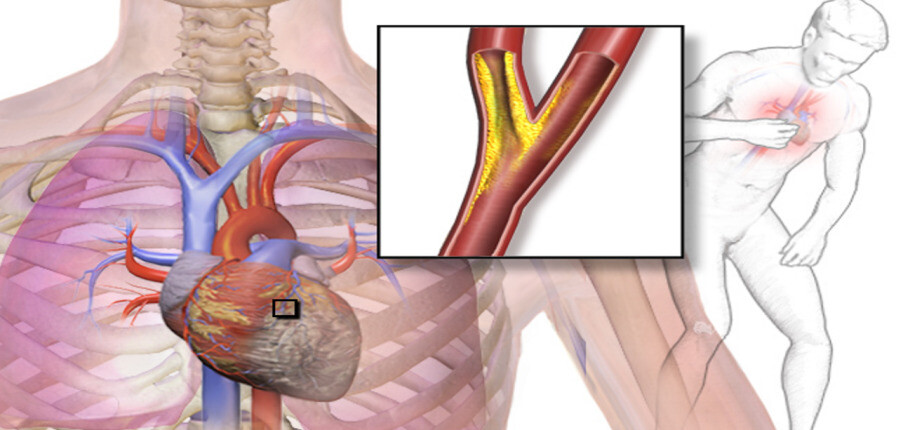 Thiếu máu cơ tim: Nguyên nhân, triệu chứng và biện pháp điều trị