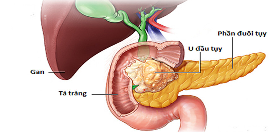 U đầu tụy và biến chứng gây tắc mật