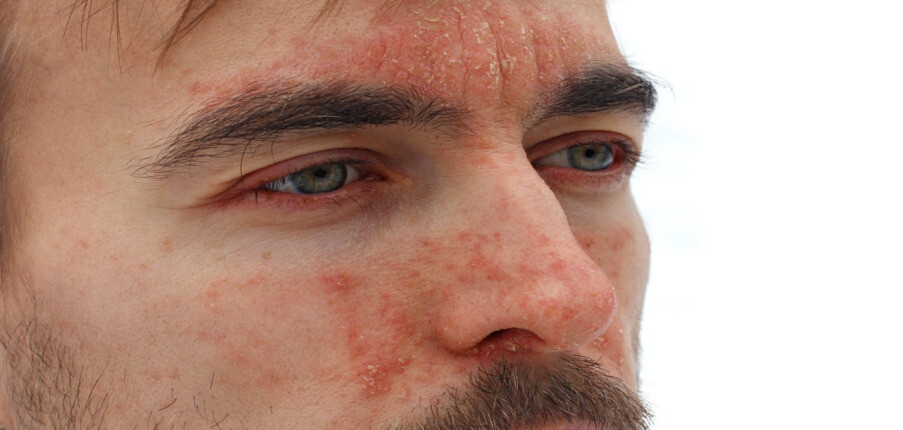 Viêm da tiết bã trên mặt: Nguyên nhân và cách điều trị