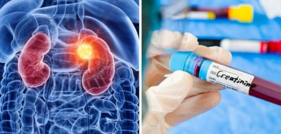 Nồng độ creatinine cao: Nguyên nhân, triệu chứng và thời điểm cần điều trị