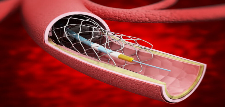 Stent mạch vành là gì? Lợi ích và rủi ro