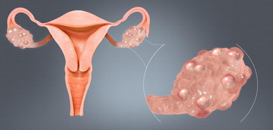 Hội chứng buồng trứng đa nang (PCOS): Nguyên nhân, triệu chứng và điều trị