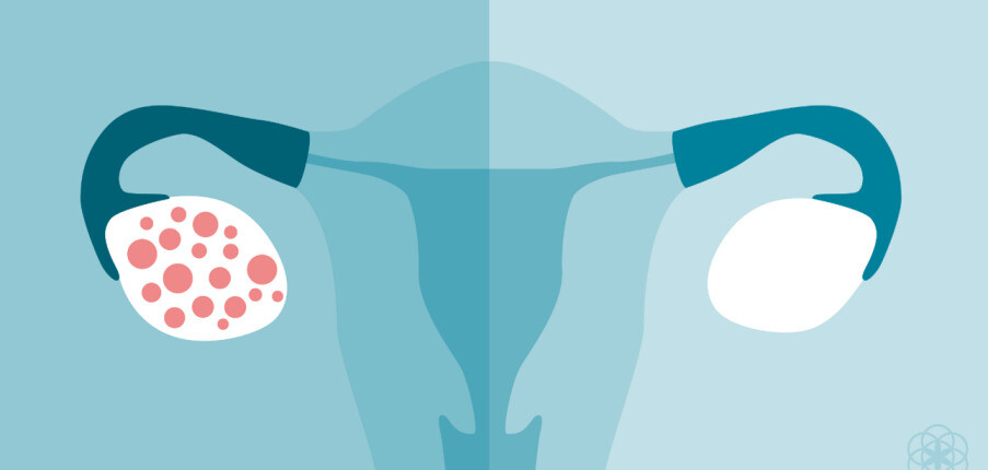 Hội chứng buồng trứng đa nang (PCOS) ảnh hưởng như thế nào đến khả năng sinh sản?